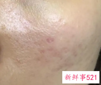 黑色痘印和红色痘印的区别