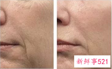 女性各年龄段出现的面部皱纹