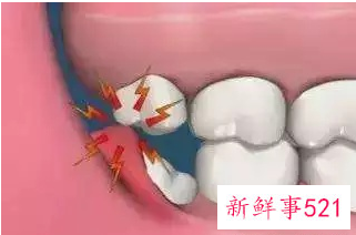 怎么看自己有没有智齿