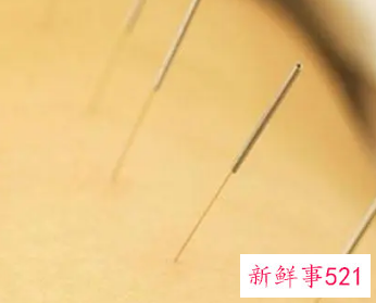 女人针灸的禁忌