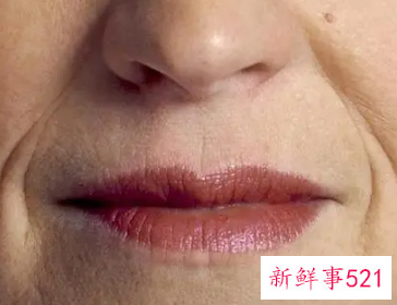 如何预防嘴周围皱纹