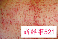 儿童皮肤病图片