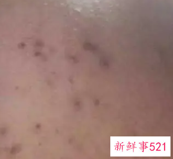 黑色痘印和红色痘印的区别