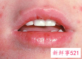 儿童皮肤病图片