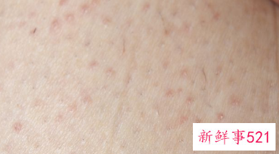 孕妇玫瑰糖疹能吃鱼吗