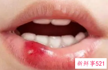 口腔溃疡怎么办最快愈合饮食吃什么好