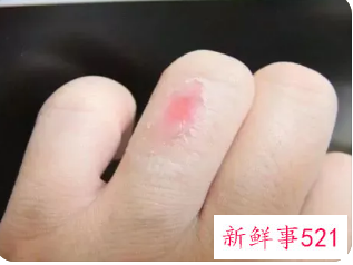 孕妇烫伤可以涂芦荟胶吗