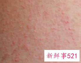 腿上突然长个痘痘很痛有脓包硬的