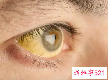 眼睛胀痛是不是肝火旺