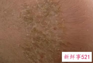 宝宝出生后头皮有鳞屑应及时清理
