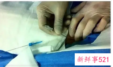 局部麻醉一般有后遗症吗