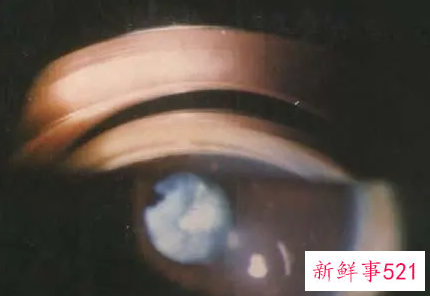 眼睛神经发育不好怎么办