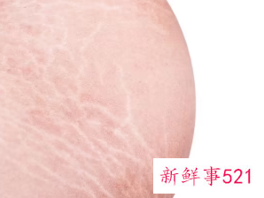 七八年的妊娠纹能去掉吗