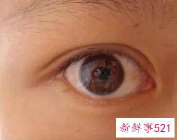 眼睛胀痛是不是肝火旺