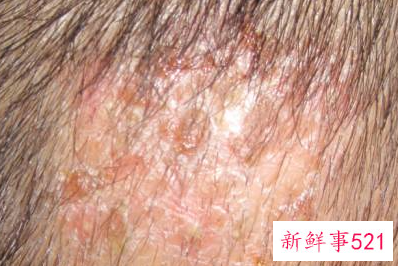 宝宝出生后头皮有鳞屑应及时清理