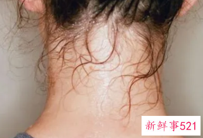 出汗为什么头部出汗多