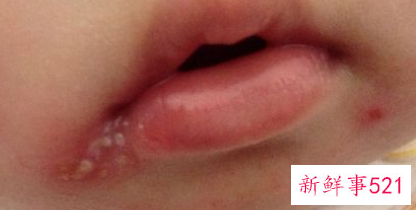 吃海鲜嘴角长泡是为什么