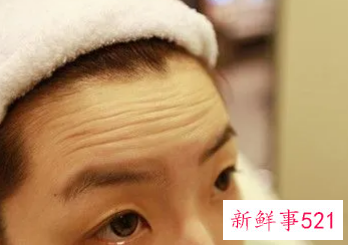 去除抬头纹小妙招