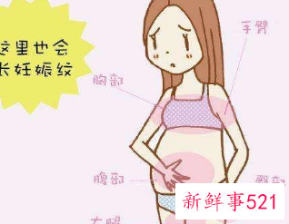 七八年的妊娠纹能去掉吗