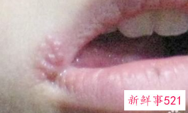 吃海鲜嘴角长泡是为什么