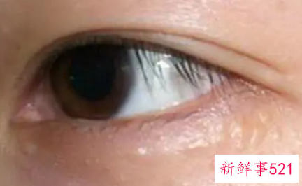 眼袋部位有脂肪粒是怎么回事