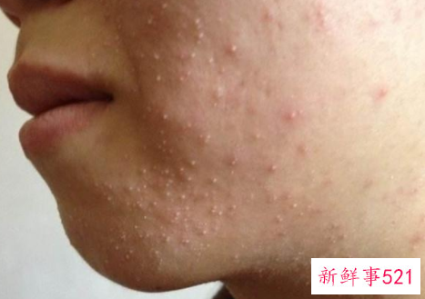 长痘的原因是什么