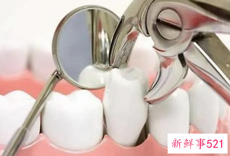 拔牙后有哪些注意事项