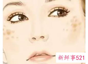 黄褐斑和日晒斑怎么区分