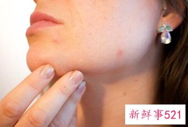 面部皮癣用什么药膏好得快