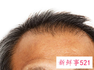 发际线后移怎么挽救