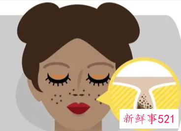 点斑期间怎么快速掉痂