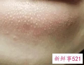 脸上起白色凸起的小米粒