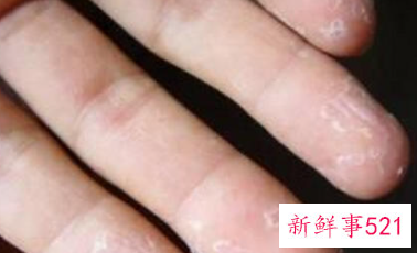 手脱皮是为什么