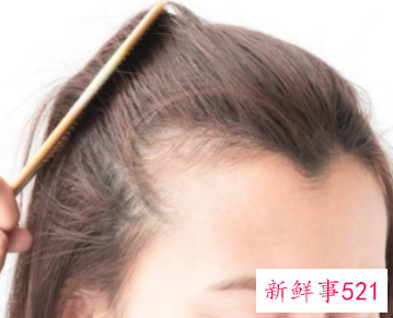 发际线后移怎么挽救