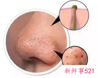 如何清理堵塞的毛孔