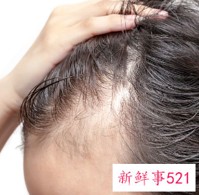 发际线后移怎么挽救