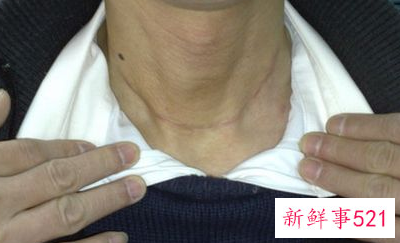 甲亢的最初症状