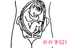 臀位一般生男孩吗