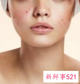 油性皮肤怎么去痘痘方法