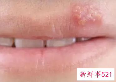 嘴角起小水泡是什么原因