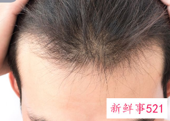 发际线后移怎么挽救