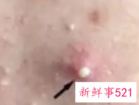痤疮不挤里面的脓会消吗