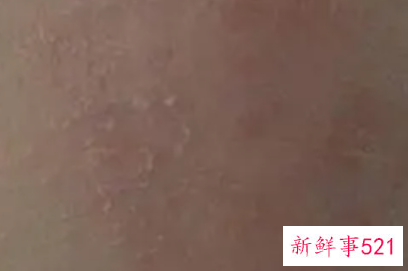 孕妇脸上长癣怎么办