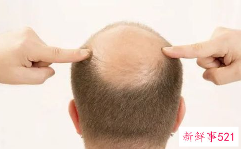 油脂分泌旺盛脱发怎么办