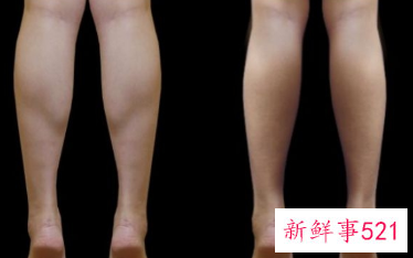 腿部吸脂7天能恢复吗