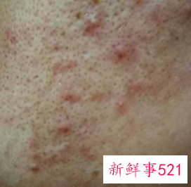 祛痘最好的药膏前10名