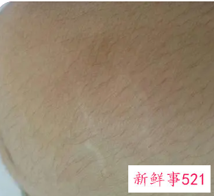 白色肥胖纹怎么形成的