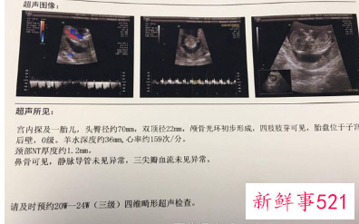 已生男宝的NT单子