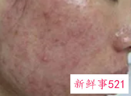 祛痘最好的药膏前10名