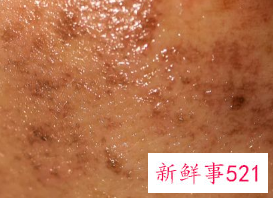 痤疮不挤里面的脓会消吗